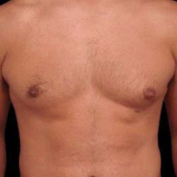 Gynecomastia Before & After Patient #3130