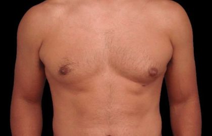 Gynecomastia Before & After Patient #3130