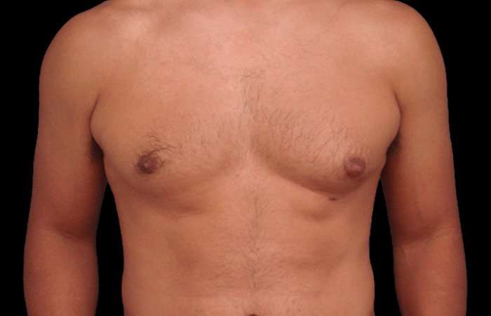 Gynecomastia Before & After Patient #3130