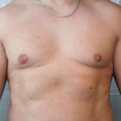 Gynecomastia Before & After Patient #3135