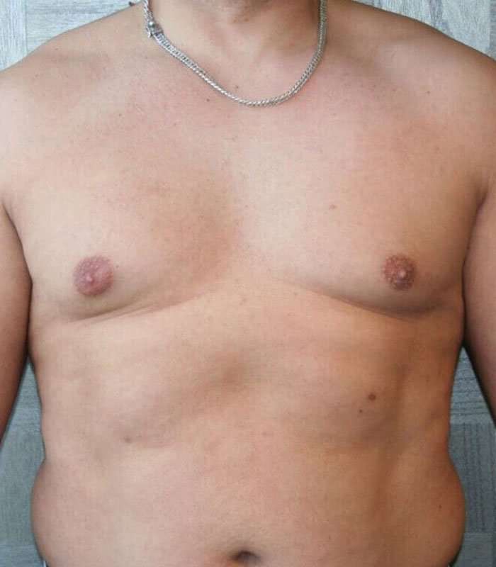 Gynecomastia Before & After Patient #3135