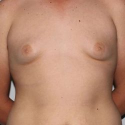 Gynecomastia Before & After Patient #3140