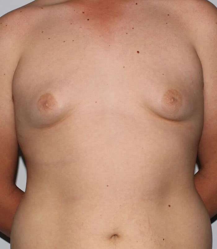 Gynecomastia Before & After Patient #3140
