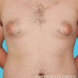 Gynecomastia Before & After Patient #3145