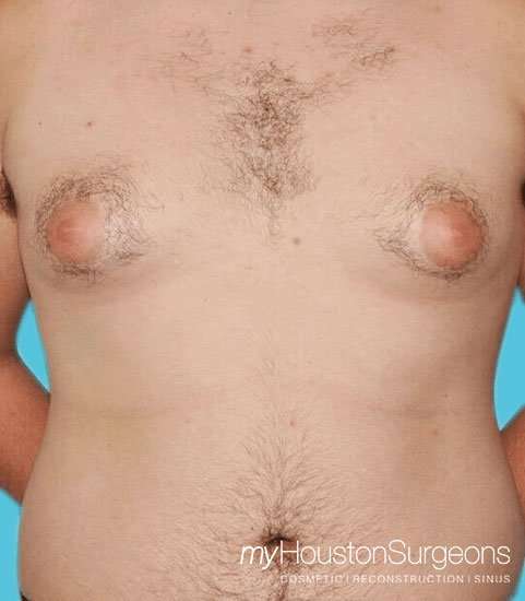 Gynecomastia Before & After Patient #3145