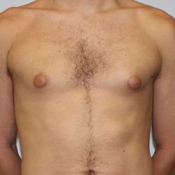 Gynecomastia Before & After Patient #3151