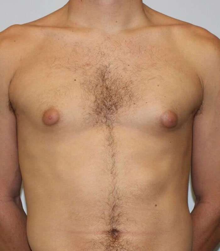 Gynecomastia Before & After Patient #3151