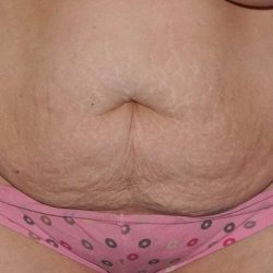 Abdominoplasty (Tummy Tuck) Before & After Patient #855