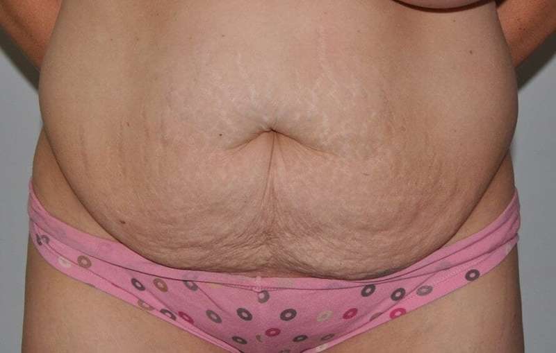 Abdominoplasty (Tummy Tuck) Before & After Patient #855
