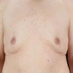Gynecomastia Before & After Patient #3162