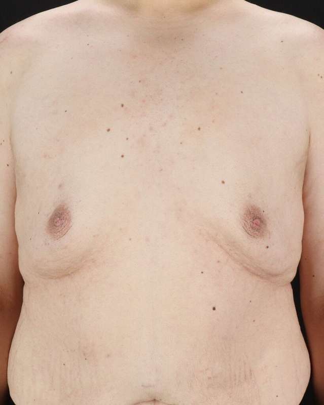 Gynecomastia Before & After Patient #3162