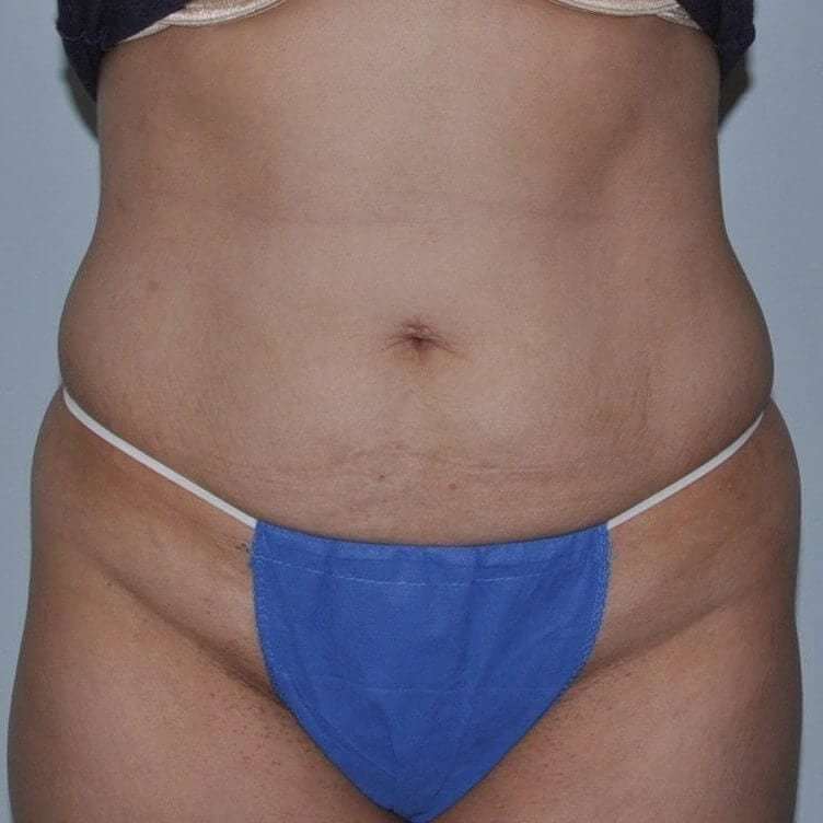 Abdominoplasty (Tummy Tuck) Before & After Patient #862