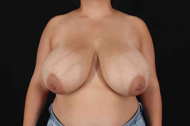 Breast Reduction With Lift Before & After Patient #3334