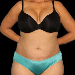 Abdominoplasty (Tummy Tuck) Before & After Patient #579