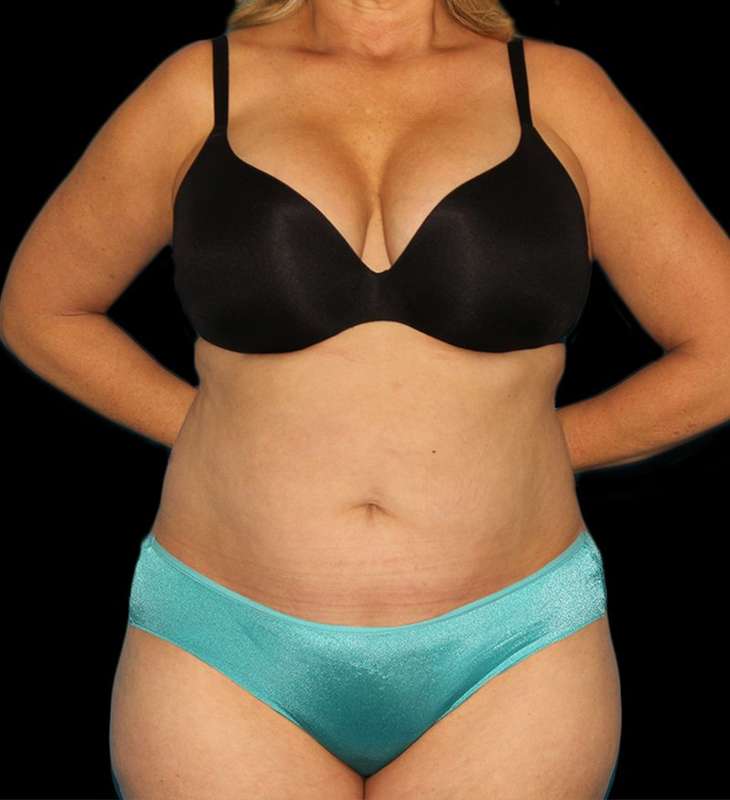 Abdominoplasty (Tummy Tuck) Before & After Patient #579