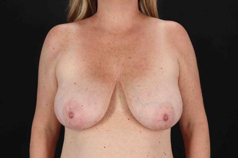 Breast Reduction With Lift Before & After Patient #3345