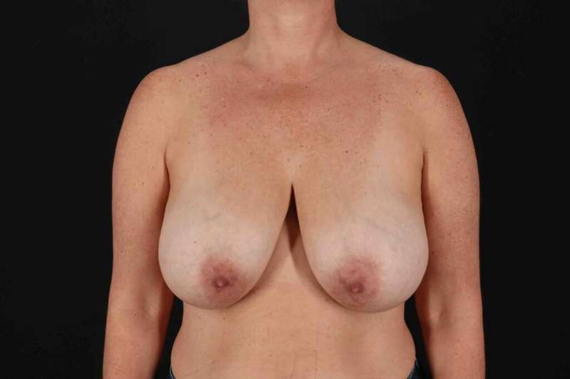 Breast Reduction With Lift Before & After Patient #3389