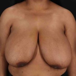 Breast Reduction With Lift Before & After Patient #3400