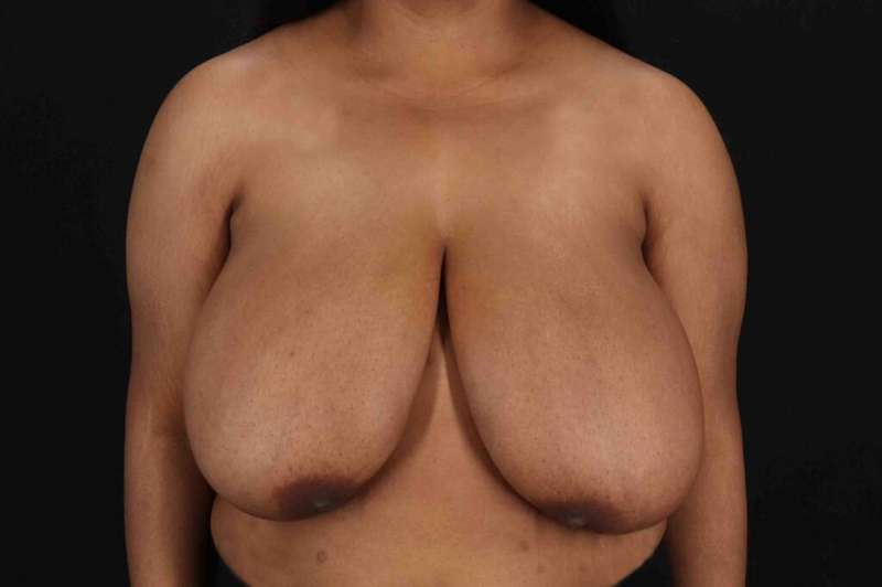 Breast Reduction With Lift Before & After Patient #3400