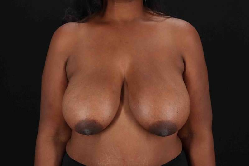 Breast Reduction With Lift Before & After Patient #3411