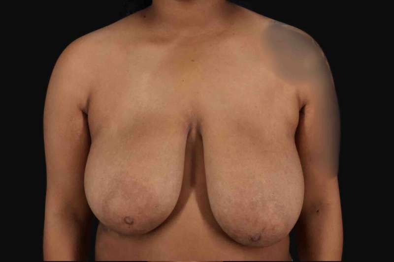 Breast Reduction With Lift Before & After Patient #3422