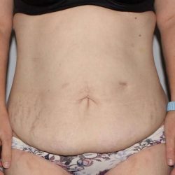 Abdominoplasty (Tummy Tuck) Before & After Patient #874