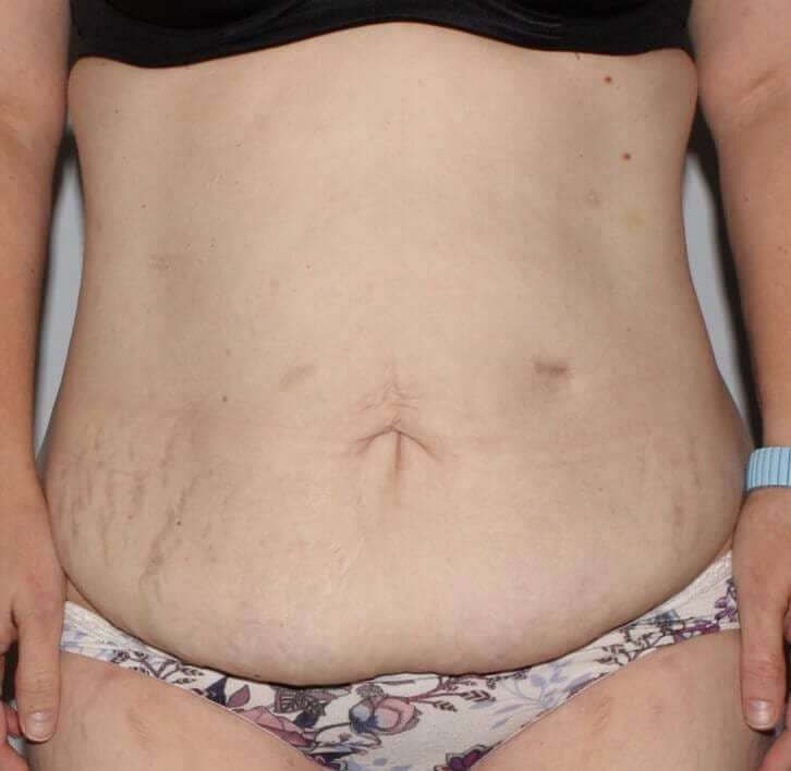 Abdominoplasty (Tummy Tuck) Before & After Patient #874