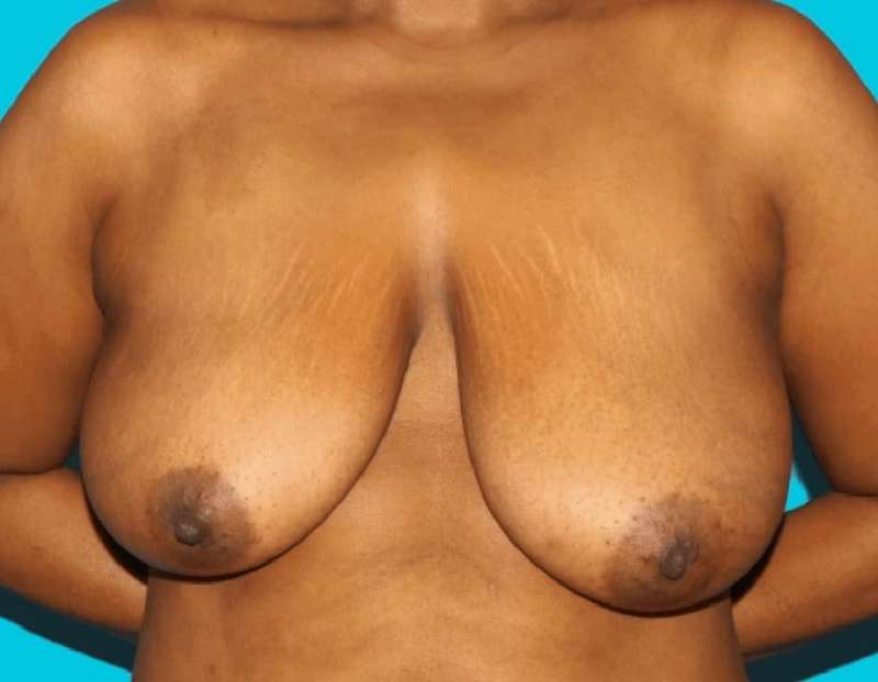 Breast Reduction With Lift Before & After Patient #3443