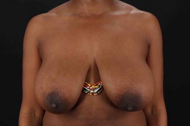 Breast Reduction With Lift Before & After Patient #3454