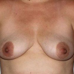 Nipple Areola Preservation (NAP) Before & After Patient #3457
