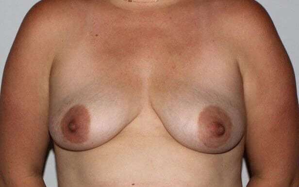 Nipple Areola Preservation (NAP) Before & After Patient #3457