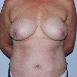 Nipple Areola Preservation (NAP) Before & After Patient #3460