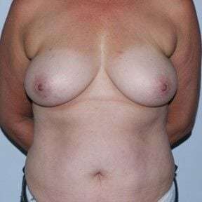 Nipple Areola Preservation (NAP) Before & After Patient #3460