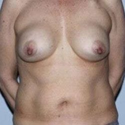 Nipple Areola Preservation (NAP) Before & After Patient #3463