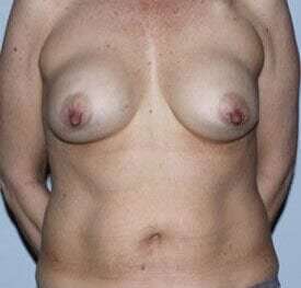 Nipple Areola Preservation (NAP) Before & After Patient #3463