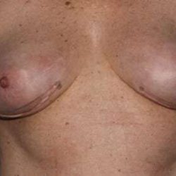 Nipple Areola Preservation (NAP) Before & After Patient #3466