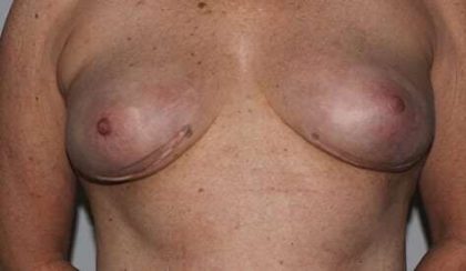 Nipple Areola Preservation (NAP) Before & After Patient #3466