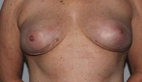 Nipple Areola Preservation (NAP) Before & After Patient #3466