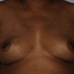 Nipple Areola Preservation (NAP) Before & After Patient #3469