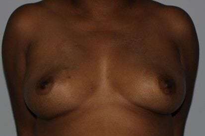 Nipple Areola Preservation (NAP) Before & After Patient #3469