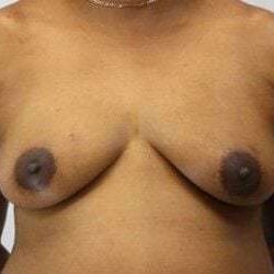 Nipple Areola Preservation (NAP) Before & After Patient #3472