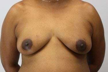 Nipple Areola Preservation (NAP) Before & After Patient #3472