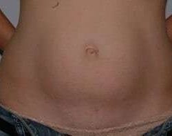 Abdominoplasty (Tummy Tuck) Before & After Patient #881