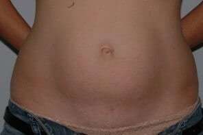 Abdominoplasty (Tummy Tuck) Before & After Patient #881