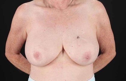 Implant Based Reconstruction Before & After Patient #3527