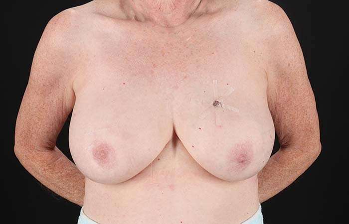 Implant Based Reconstruction Before & After Patient #3527
