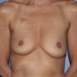 Implant Based Reconstruction Before & After Patient #3538