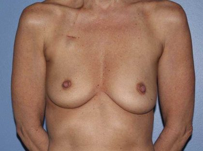 Implant Based Reconstruction Before & After Patient #3538