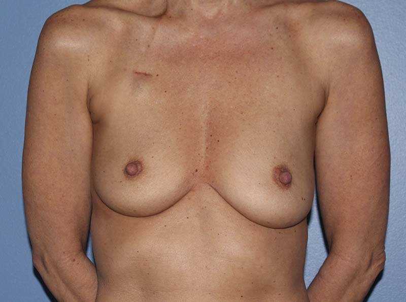 Implant Based Reconstruction Before & After Patient #3538