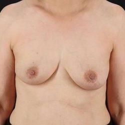 Implant Based Reconstruction Before & After Patient #3549